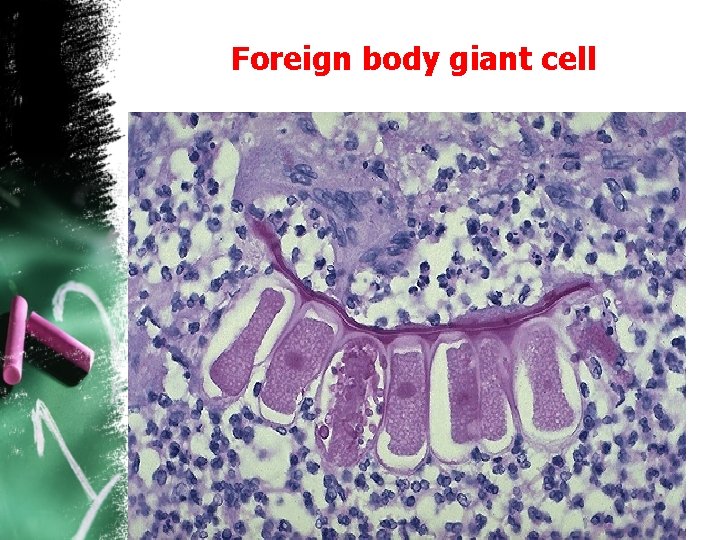Foreign body giant cell 