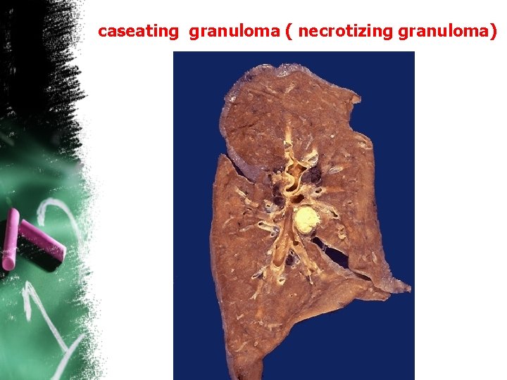 caseating granuloma ( necrotizing granuloma) 