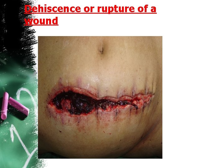 Dehiscence or rupture of a wound 
