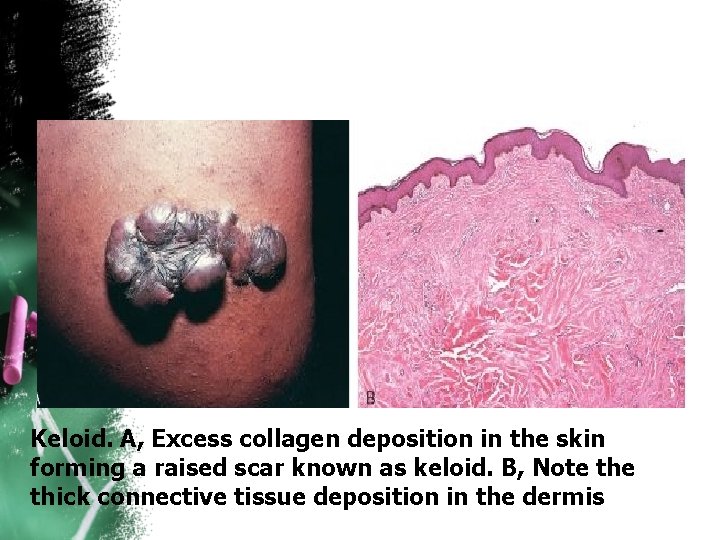 Keloid. A, Excess collagen deposition in the skin forming a raised scar known as