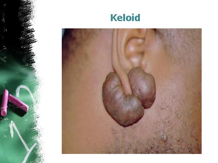 Keloid 