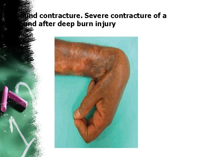 Wound contracture. Severe contracture of a wound after deep burn injury 