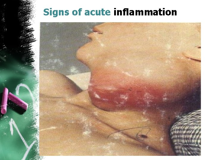 Signs of acute inflammation 