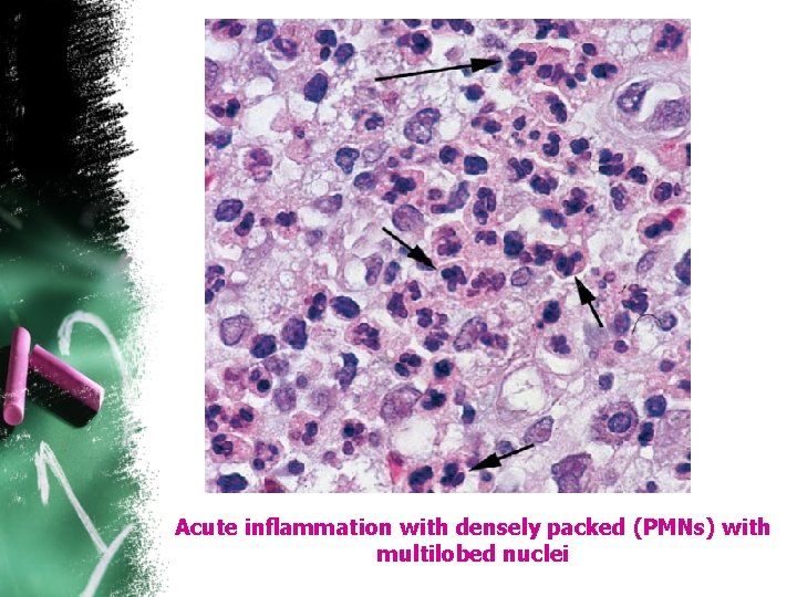 Acute inflammation with densely packed (PMNs) with multilobed nuclei 
