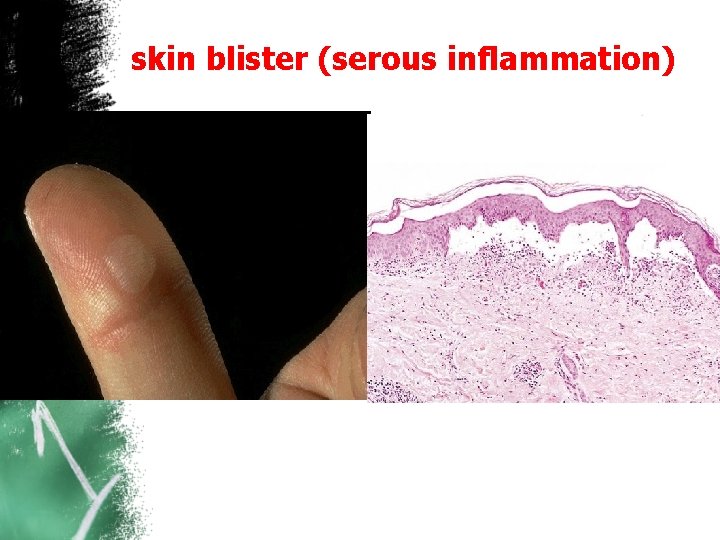 skin blister (serous inflammation) 