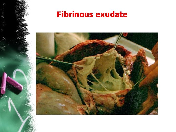 Fibrinous exudate 