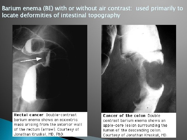 Barium enema (BE) with or without air contrast: used primarily to locate deformities of