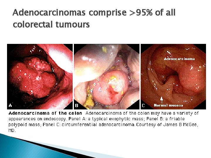 Adenocarcinomas comprise >95% of all colorectal tumours 