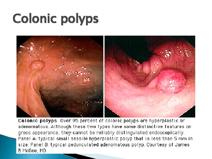 Colonic polyps 