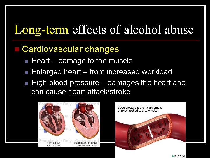 Long-term effects of alcohol abuse n Cardiovascular changes n n n Heart – damage