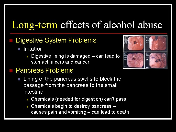 Long-term effects of alcohol abuse n Digestive System Problems n Irritation n n Digestive