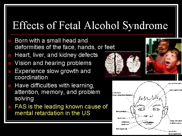 Effects of Fetal Alcohol Syndrome n n n Born with a small head and