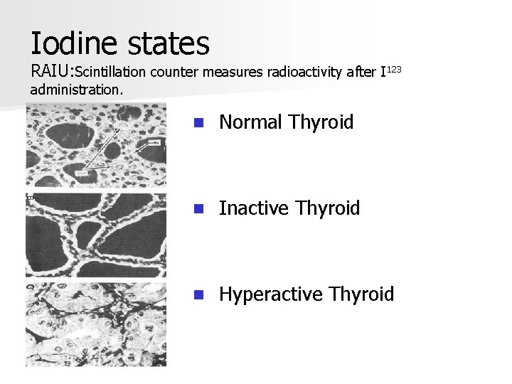 Iodine states RAIU: Scintillation counter measures radioactivity after I 123 administration. n Normal Thyroid