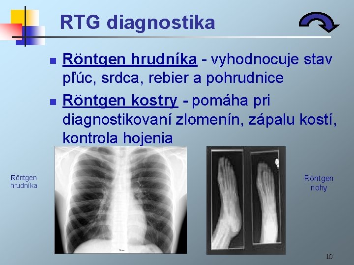 RTG diagnostika n n Röntgen hrudníka - vyhodnocuje stav pľúc, srdca, rebier a pohrudnice