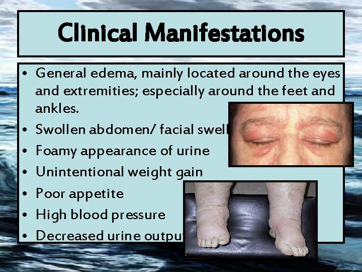 Clinical Manifestations • General edema, mainly located around the eyes and extremities; especially around