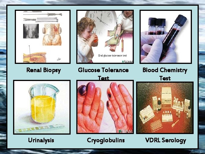 Renal Biopsy Urinalysis Glucose Tolerance Test Cryoglobulins Blood Chemistry Test VDRL Serology 