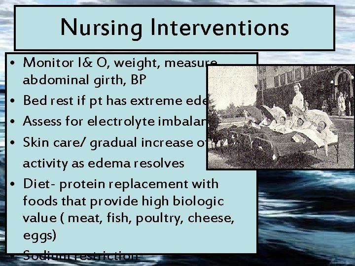 Nursing Interventions • Monitor I& O, weight, measure abdominal girth, BP • Bed rest