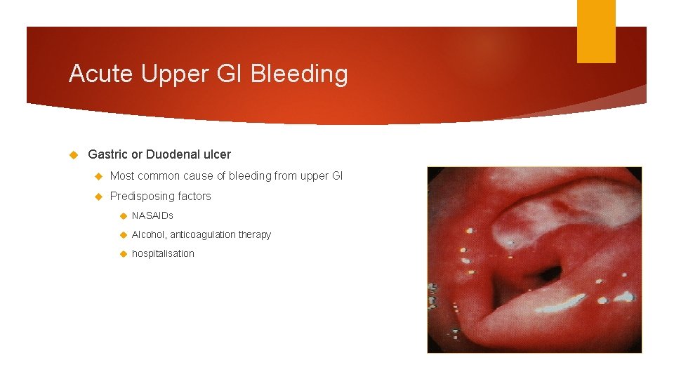 Acute Upper GI Bleeding Gastric or Duodenal ulcer Most common cause of bleeding from Acute Upper GI Bleeding Gastric or Duodenal ulcer Most common cause of bleeding from