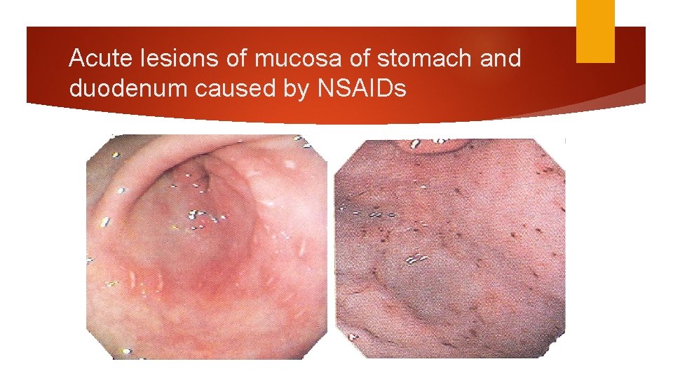 Acute lesions of mucosa of stomach and duodenum caused by NSAIDs Acute lesions of mucosa of stomach and duodenum caused by NSAIDs