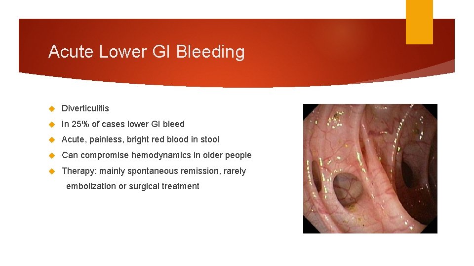 Acute Lower GI Bleeding Diverticulitis In 25% of cases lower GI bleed Acute, painless, Acute Lower GI Bleeding Diverticulitis In 25% of cases lower GI bleed Acute, painless,