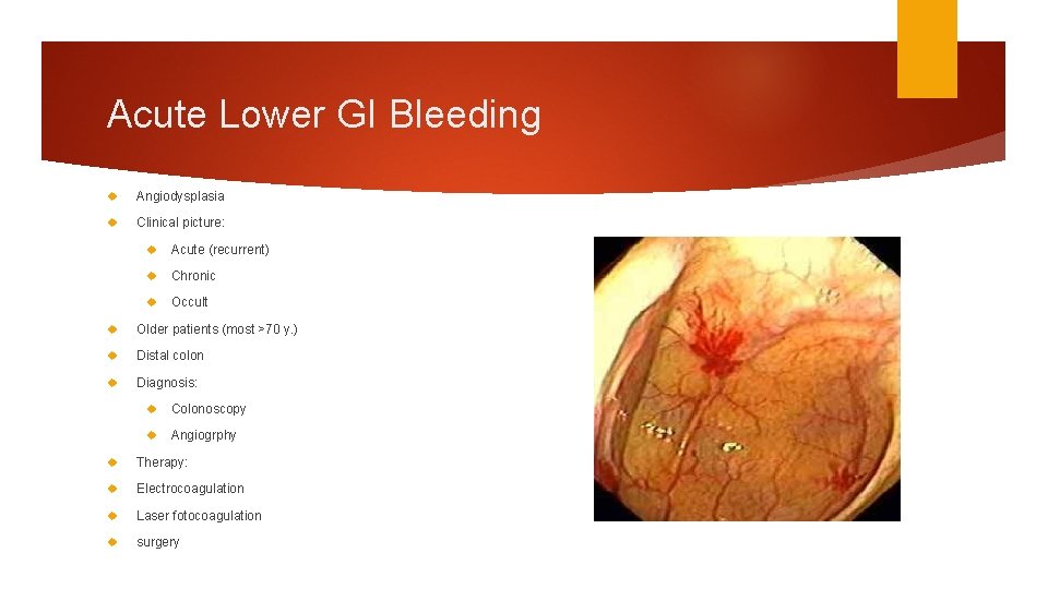 Acute Lower GI Bleeding Angiodysplasia Clinical picture: Acute (recurrent) Chronic Occult Older patients (most Acute Lower GI Bleeding Angiodysplasia Clinical picture: Acute (recurrent) Chronic Occult Older patients (most