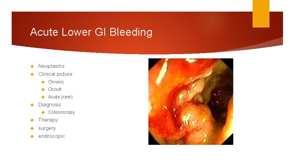 Acute Lower GI Bleeding Neoplasms Clinical picture: Chronic Occult Acute (rare) Diagnosis Colonoscopy Therapy: Acute Lower GI Bleeding Neoplasms Clinical picture: Chronic Occult Acute (rare) Diagnosis Colonoscopy Therapy: