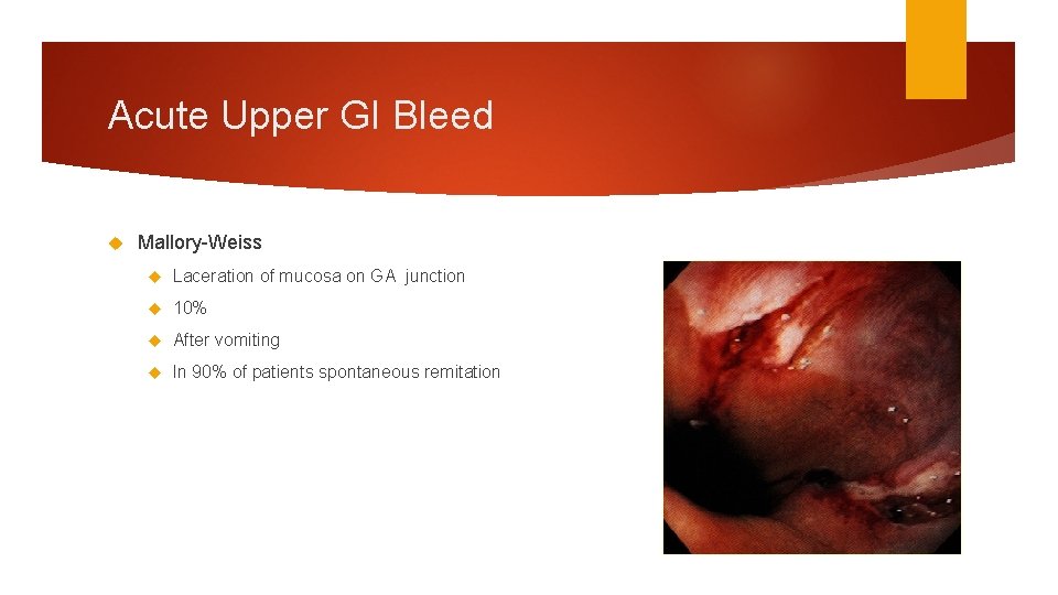 Acute Upper GI Bleed Mallory-Weiss Laceration of mucosa on GA junction 10% After vomiting Acute Upper GI Bleed Mallory-Weiss Laceration of mucosa on GA junction 10% After vomiting