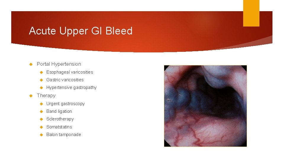Acute Upper GI Bleed Portal Hypertension Esophageal varicosities Gastric varicosities Hypertensive gastropathy Therapy Urgent Acute Upper GI Bleed Portal Hypertension Esophageal varicosities Gastric varicosities Hypertensive gastropathy Therapy Urgent