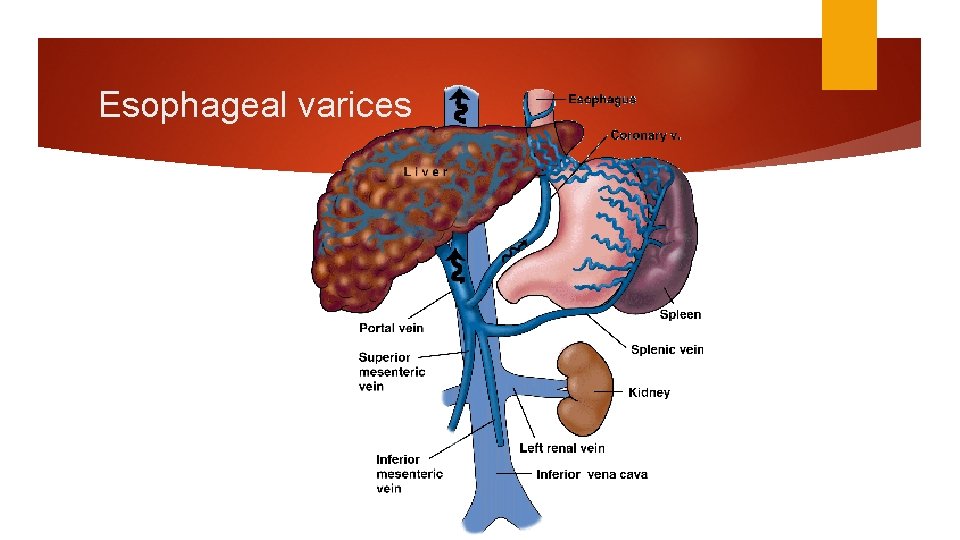 Esophageal varices Esophageal varices