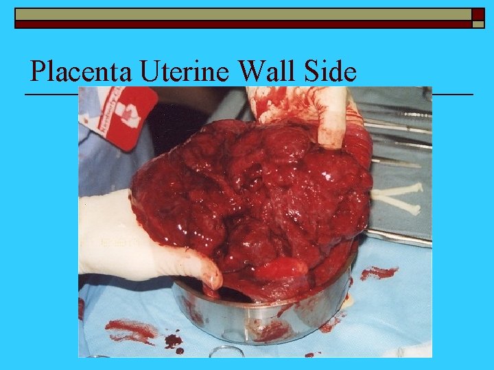 Placenta Uterine Wall Side 