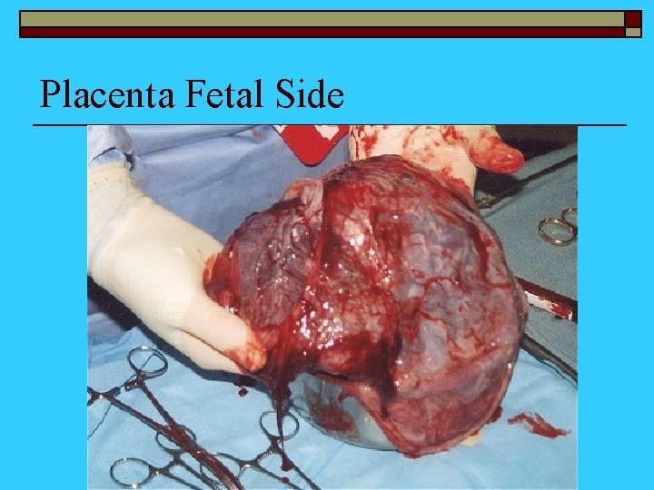 Placenta Fetal Side 