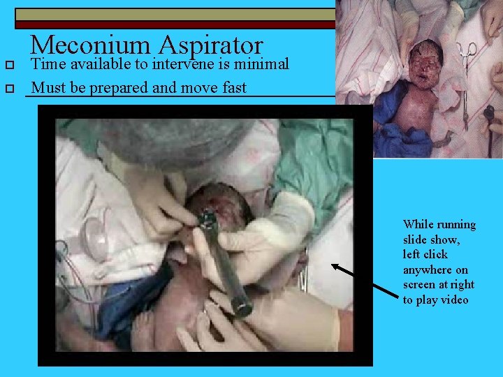 o o Meconium Aspirator Time available to intervene is minimal Must be prepared and