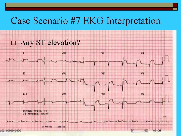 Case Scenario #7 EKG Interpretation o Any ST elevation? 