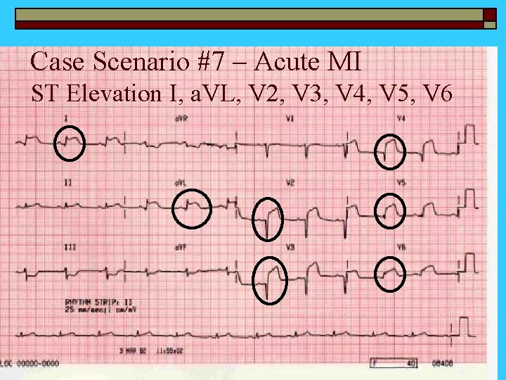 Case Scenario #7 – Acute MI ST Elevation I, a. VL, V 2, V