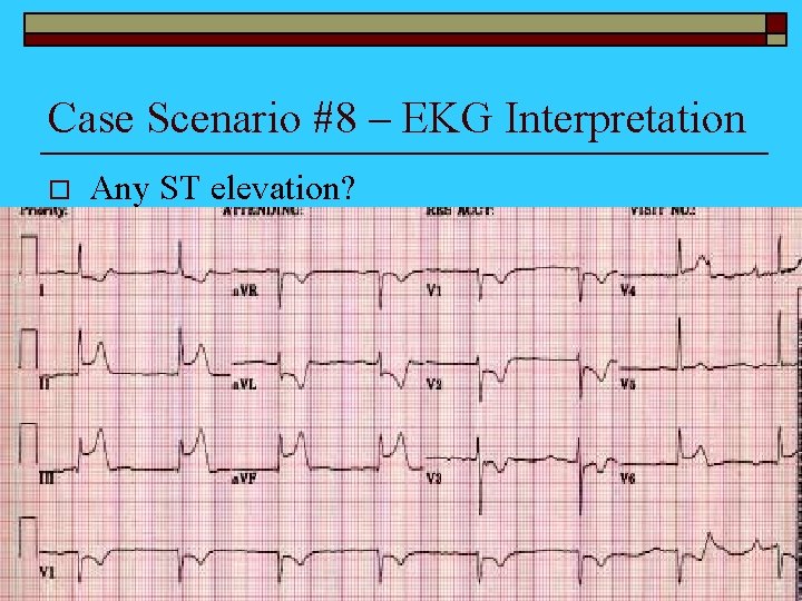 Case Scenario #8 – EKG Interpretation o Any ST elevation? 