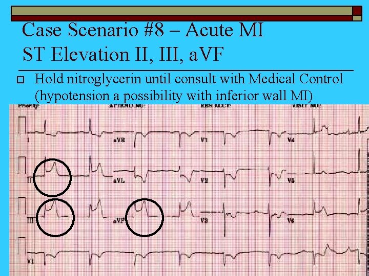 Case Scenario #8 – Acute MI ST Elevation II, III, a. VF o Hold