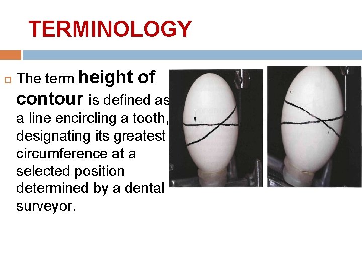 TERMINOLOGY The term height of contour is defined as a line encircling a tooth,