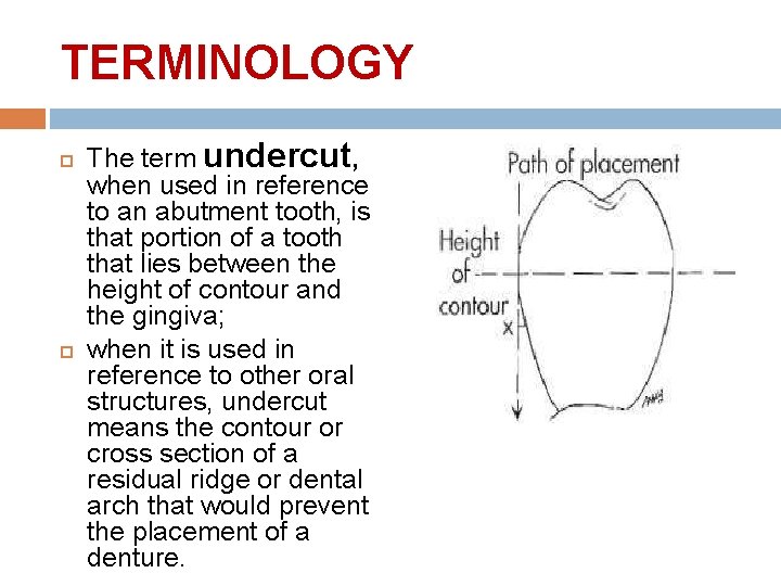 TERMINOLOGY The term undercut, when used in reference to an abutment tooth, is that