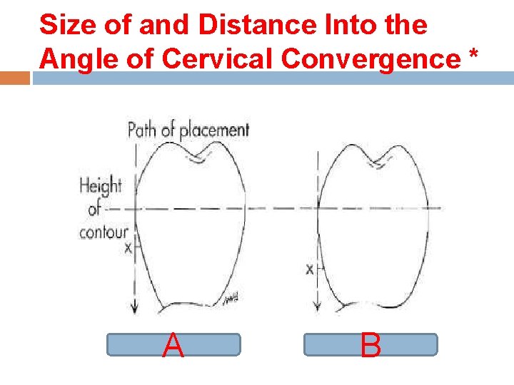 Size of and Distance Into the Angle of Cervical Convergence * A B 