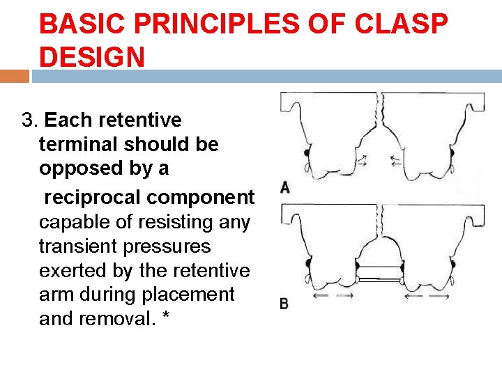 BASIC PRINCIPLES OF CLASP DESIGN 3. Each retentive terminal should be opposed by a