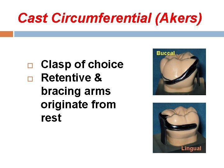 Cast Circumferential (Akers) Buccal Clasp of choice Retentive & bracing arms originate from rest