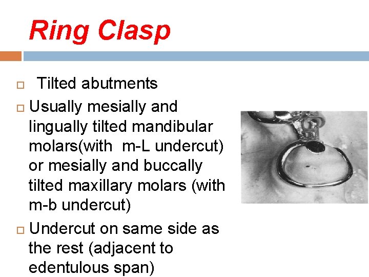 Ring Clasp Tilted abutments Usually mesially and lingually tilted mandibular molars(with m-L undercut) or