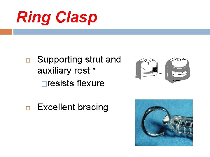 Ring Clasp Supporting strut and auxiliary rest * �resists flexure Excellent bracing 