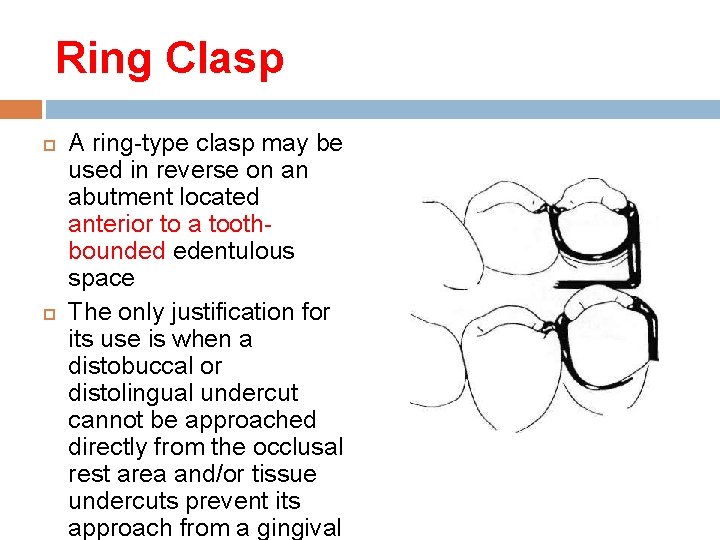 Ring Clasp A ring-type clasp may be used in reverse on an abutment located