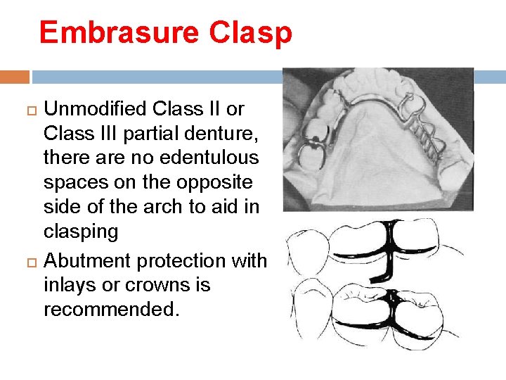 Embrasure Clasp Unmodified Class II or Class III partial denture, there are no edentulous