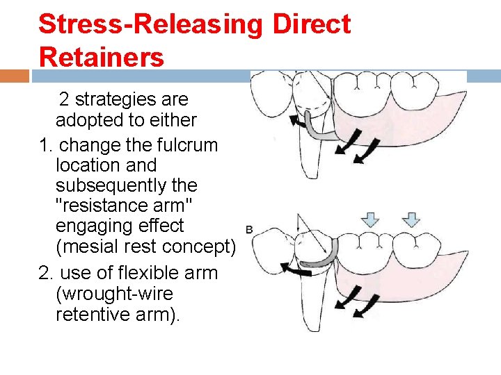 Stress-Releasing Direct Retainers 2 strategies are adopted to either 1. change the fulcrum location