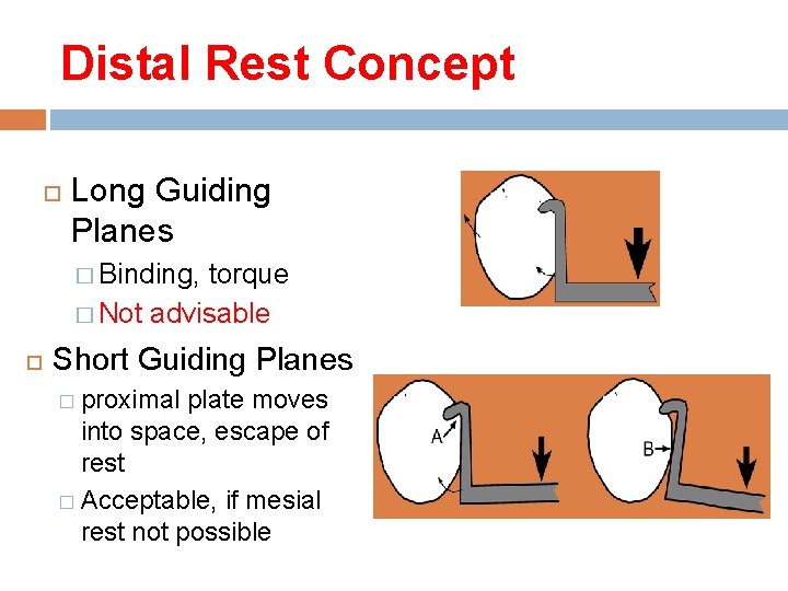 Distal Rest Concept Long Guiding Planes � Binding, torque � Not advisable Short Guiding
