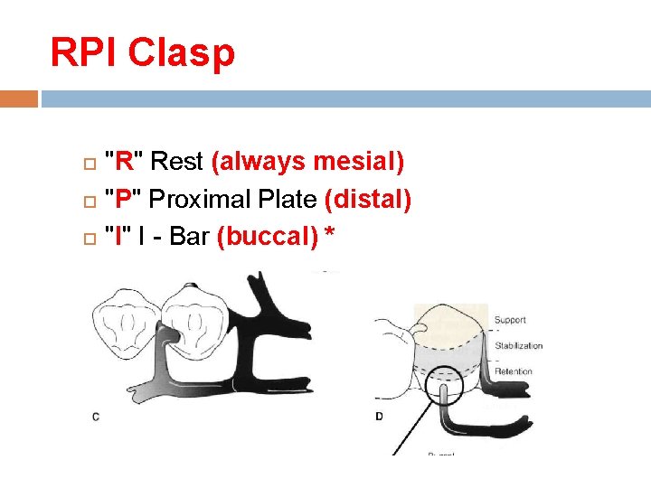 RPI Clasp "R" Rest (always mesial) "P" Proximal Plate (distal) "I" I - Bar