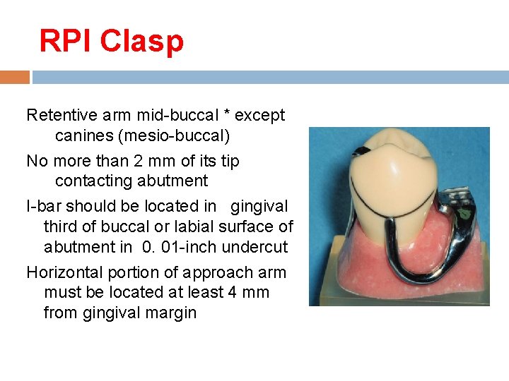 RPI Clasp Retentive arm mid-buccal * except canines (mesio-buccal) No more than 2 mm