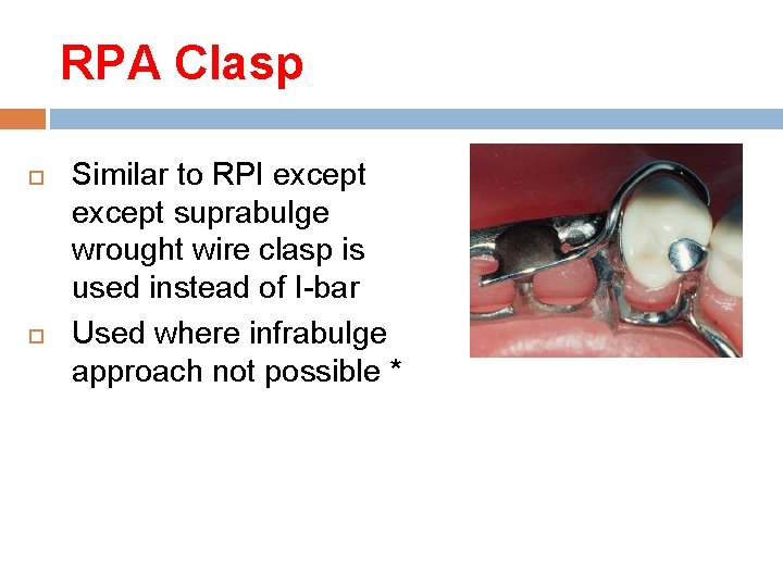 RPA Clasp Similar to RPI except suprabulge wrought wire clasp is used instead of